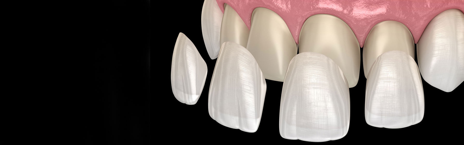 All About Porcelain Veneers