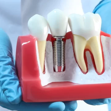 How Does Bone Grafting for Dental Implant Work?