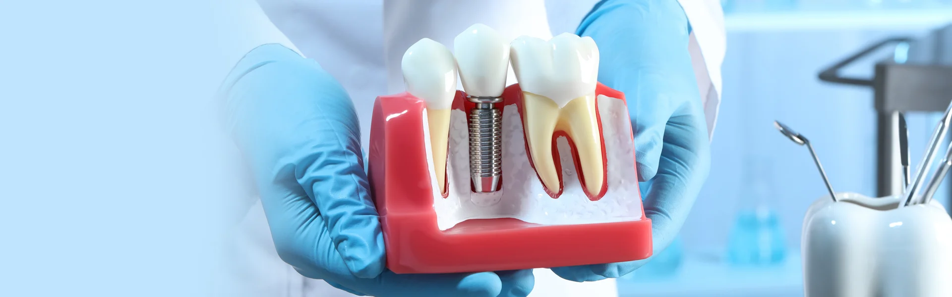 How Does Bone Grafting for Dental Implant Work?