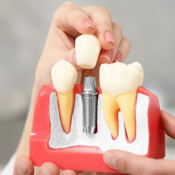 Dental Implant Stages: What to Expect