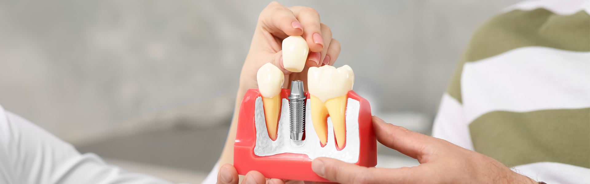 Dental Implant Stages: What to Expect