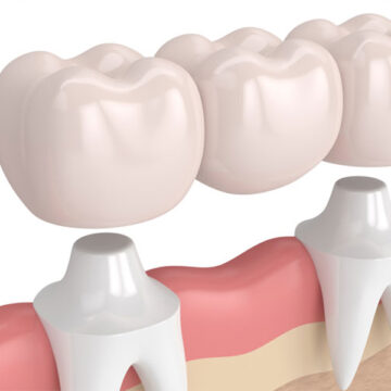 Can Dental Crowns Fix Cosmetic Issues? A Look at Aesthetic Benefits