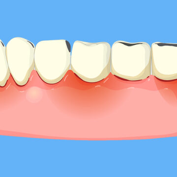 How Gum Disease Affects Your Overall Health and Why Treatment Matters