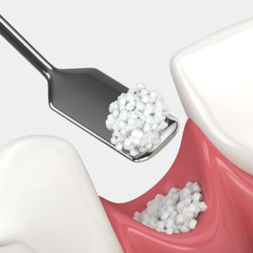 Why Seniors Might Need Bone Grafting for Dental Health
