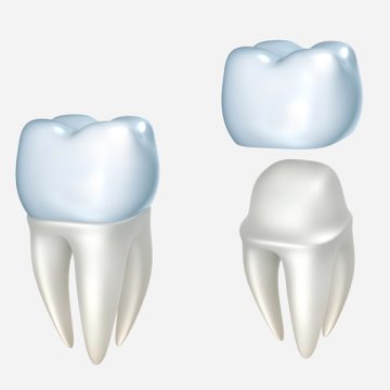 Same-Day Crowns at KK Dental
