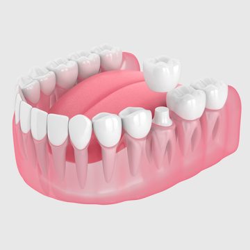 How Long Do Same-Day Dental Crowns Last? Durability and Maintenance Tips