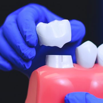 Is a Same-Day Crown Right for You? Factors to Consider Before Making a Decision