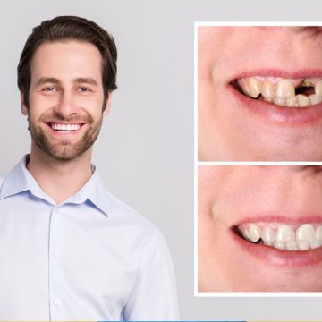 Understanding Same-Day Dental Crowns: What You Need to Know