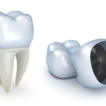 What Are the Advantages of Same-Day Crowns for Cosmetic Dentistry?