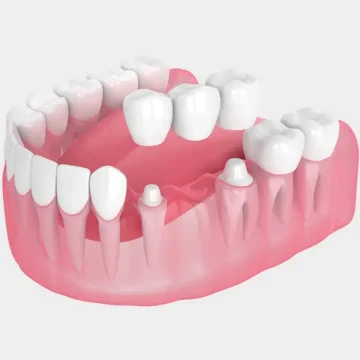 The Different Types of Dental Bridges Available in Somerset