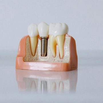 How PPO Dental Insurance Works for Dental Implants