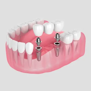 Already Our Patient? Unlock Your Free Dental Implant Scan — Here’s Why You Shouldn’t Wait
