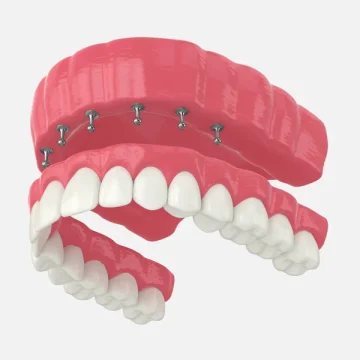 Implant-Supported Dentures in Somerset: A Secure Solution for Missing Teeth
