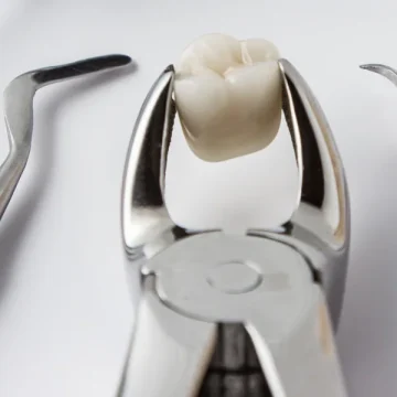 Simple vs. Surgical Tooth Extraction: What’s the Difference?